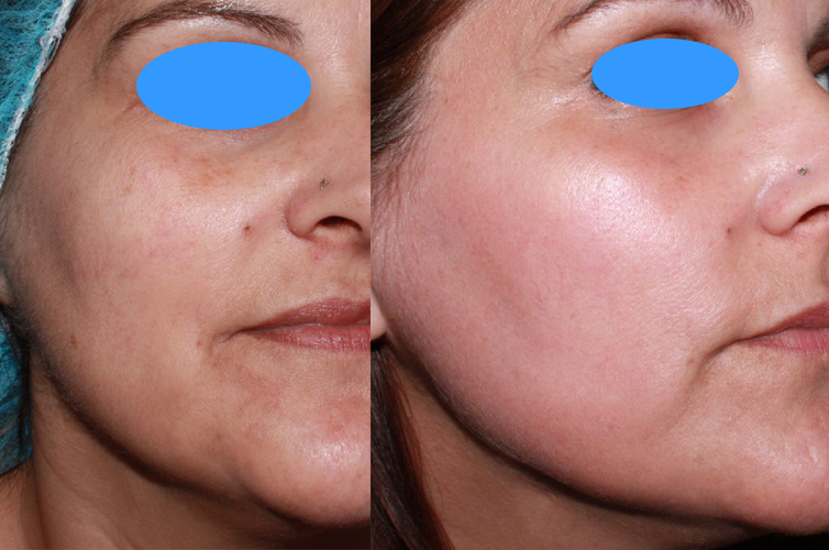 Elimina manchas con laser