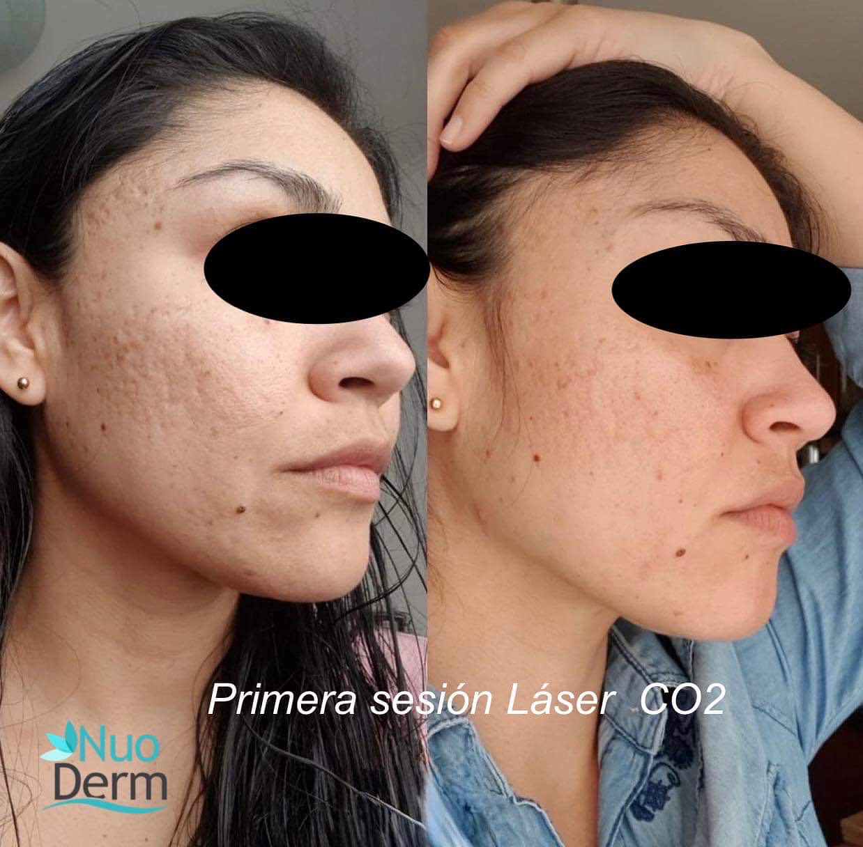 laser en cicatrices clinica franco toluca