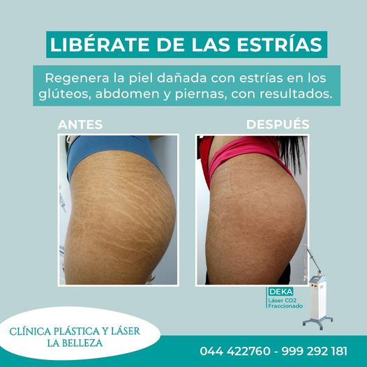 LASER PICOSECOND para estrias