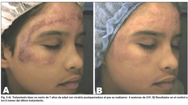 LASER en cicatrices por quemaduras