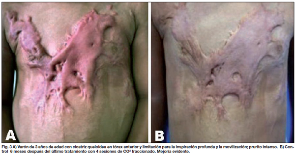 LASER NEODIMIO EN cicatrices por QUELOIDES