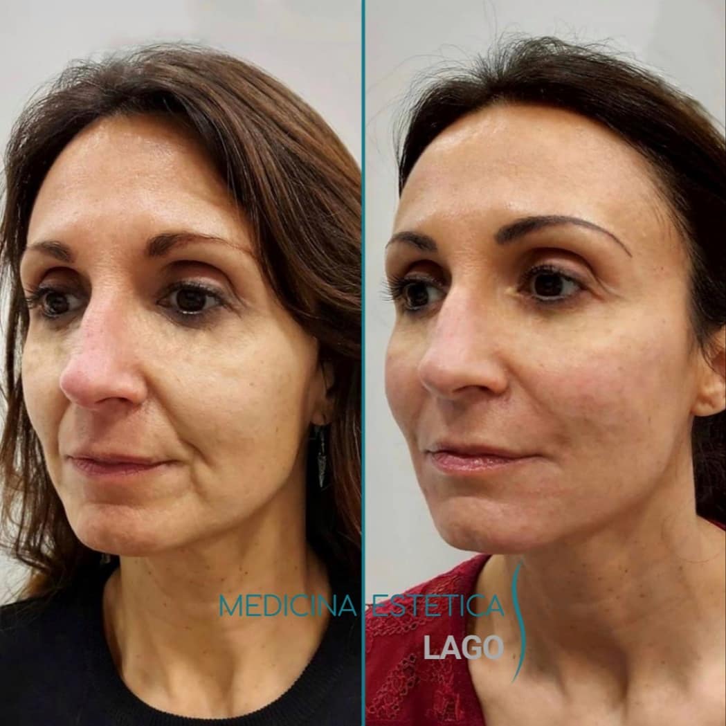 Peeling hollywood peeling