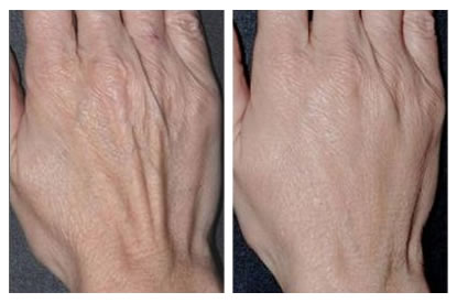 rejuvenecimiento de manos con laser