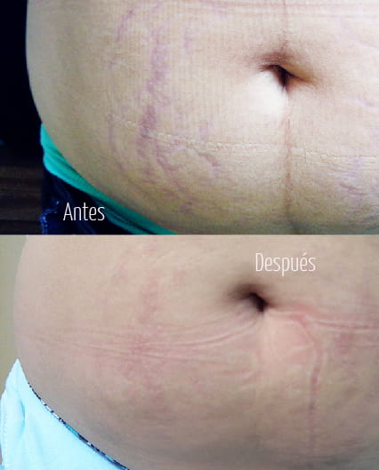 LASER YAG para estrias abdomen