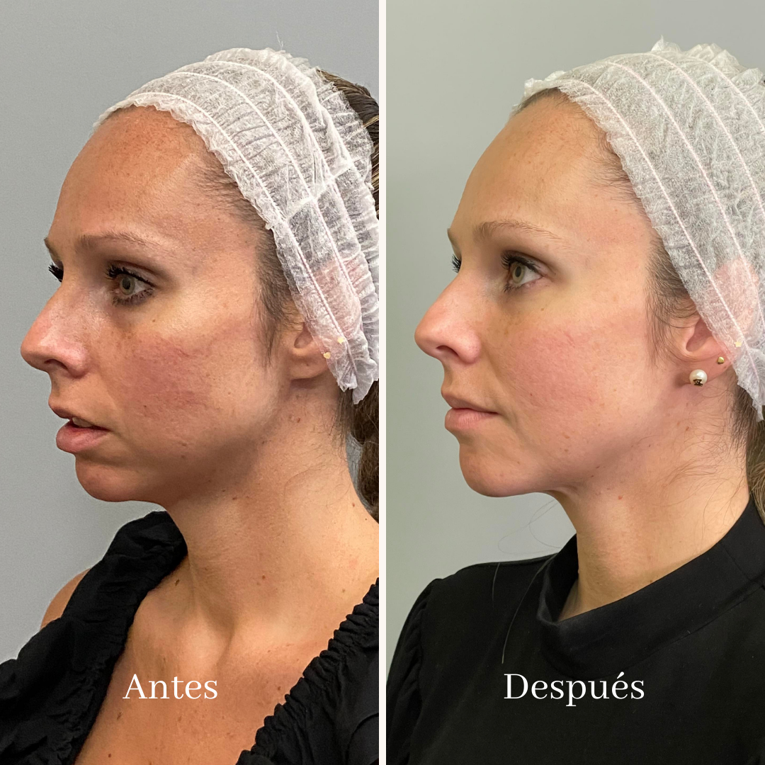 Resurfacing y Lifting con LASER