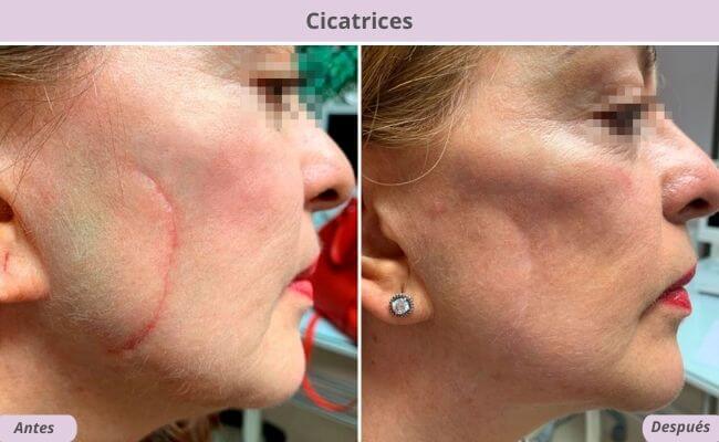 LASER YAG en cicatrices grandes