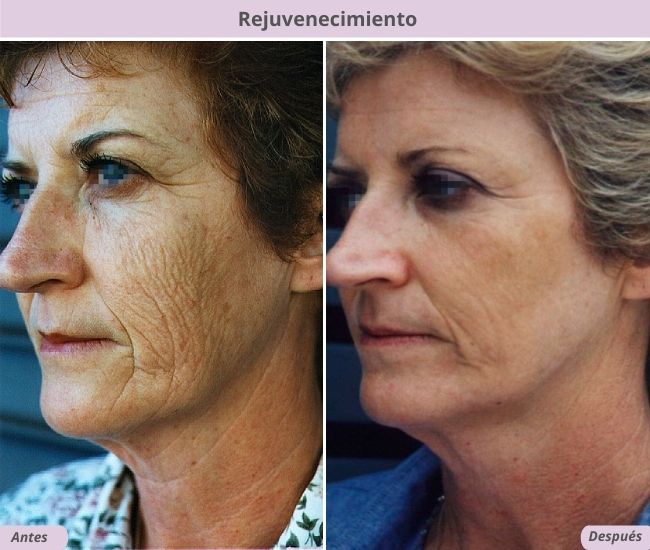 LASER yag en arrugas profundas