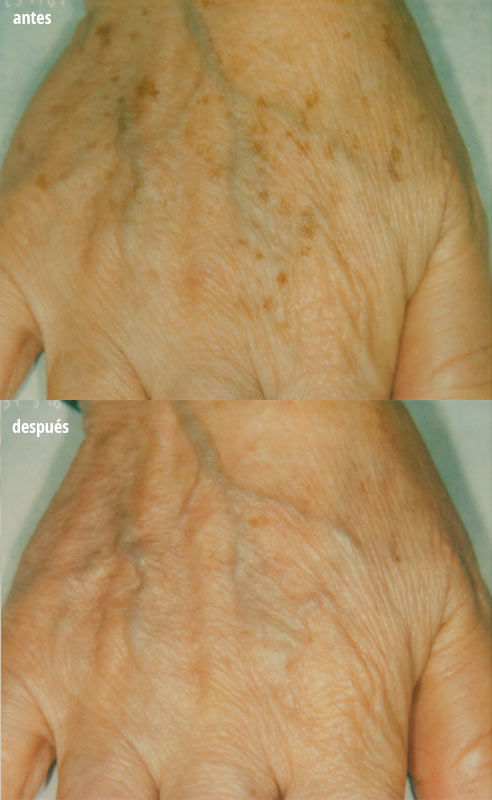 Laser para arrugas de manos