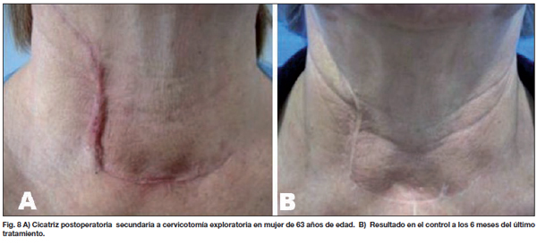 desvanecimiento de cicatrices postquirurgicas